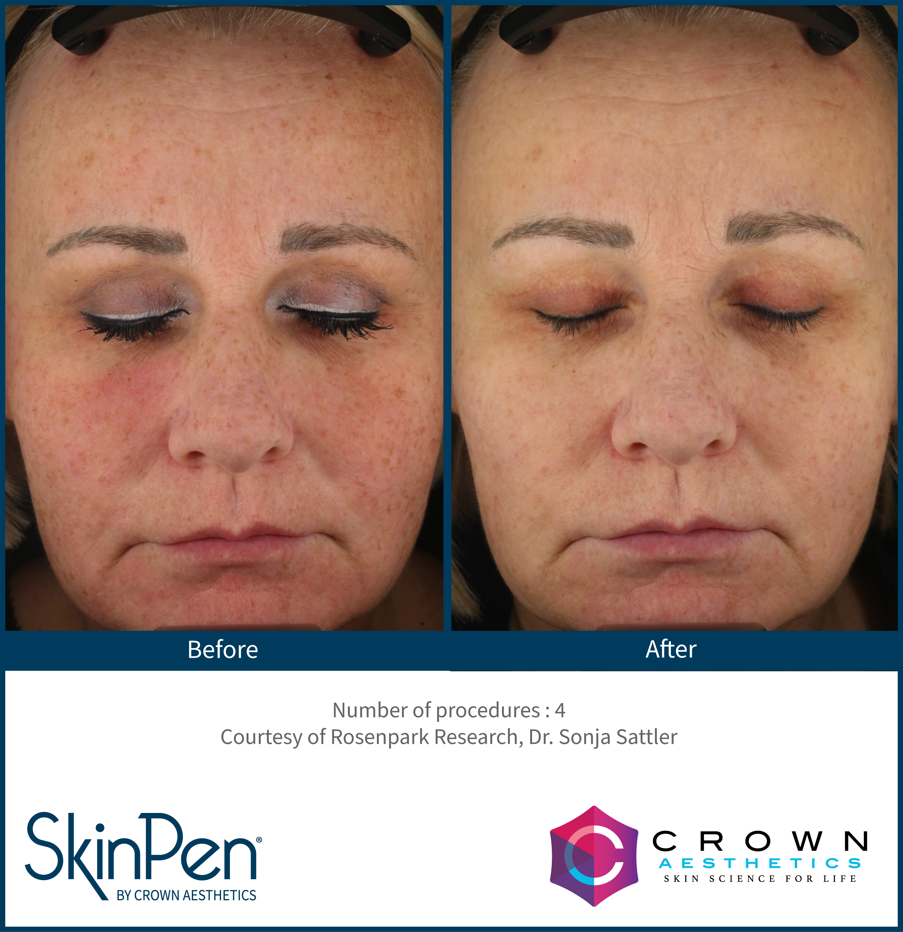 SkinPen pigmentation result example two